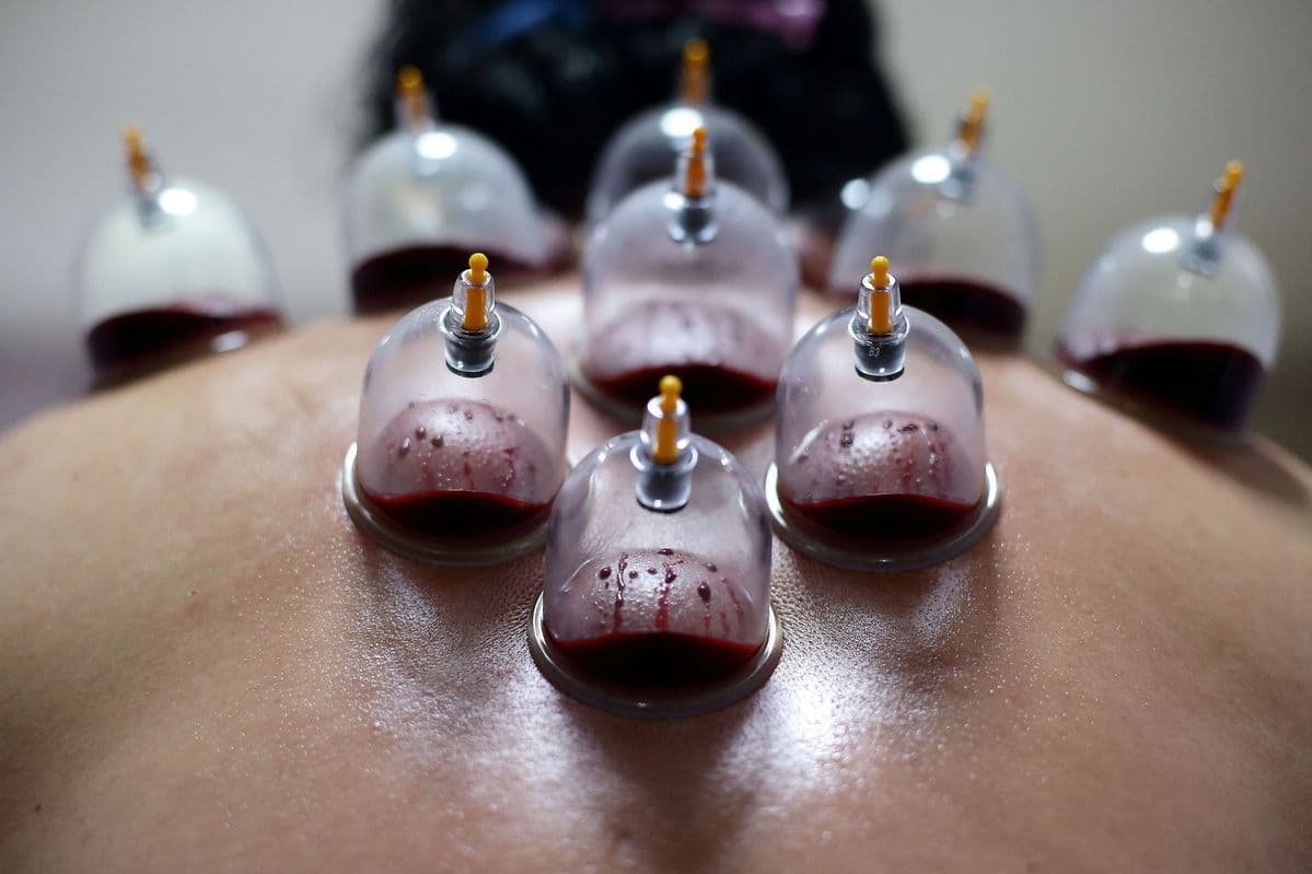 Dry Cupping Placement